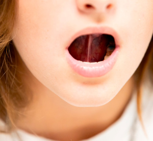 Les freins restrictifs buccaux dans la prise en soins orthophonique
